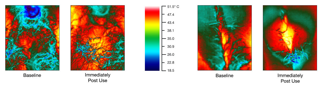 Several images of thermal scans of the vagina and surrounding tissue before and after use of the Joylux vFit device demonstrating increased blood flow and heat